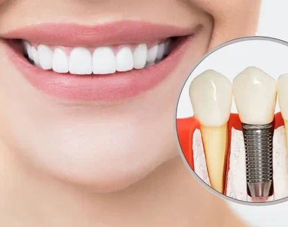 From Consultation to Recovery: What to Expect With Dental Implants at Lions Gate Dental? 